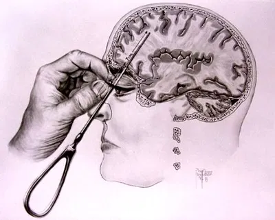 Anthony - Your lobotomized friend