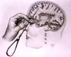 Lobotomy Patient