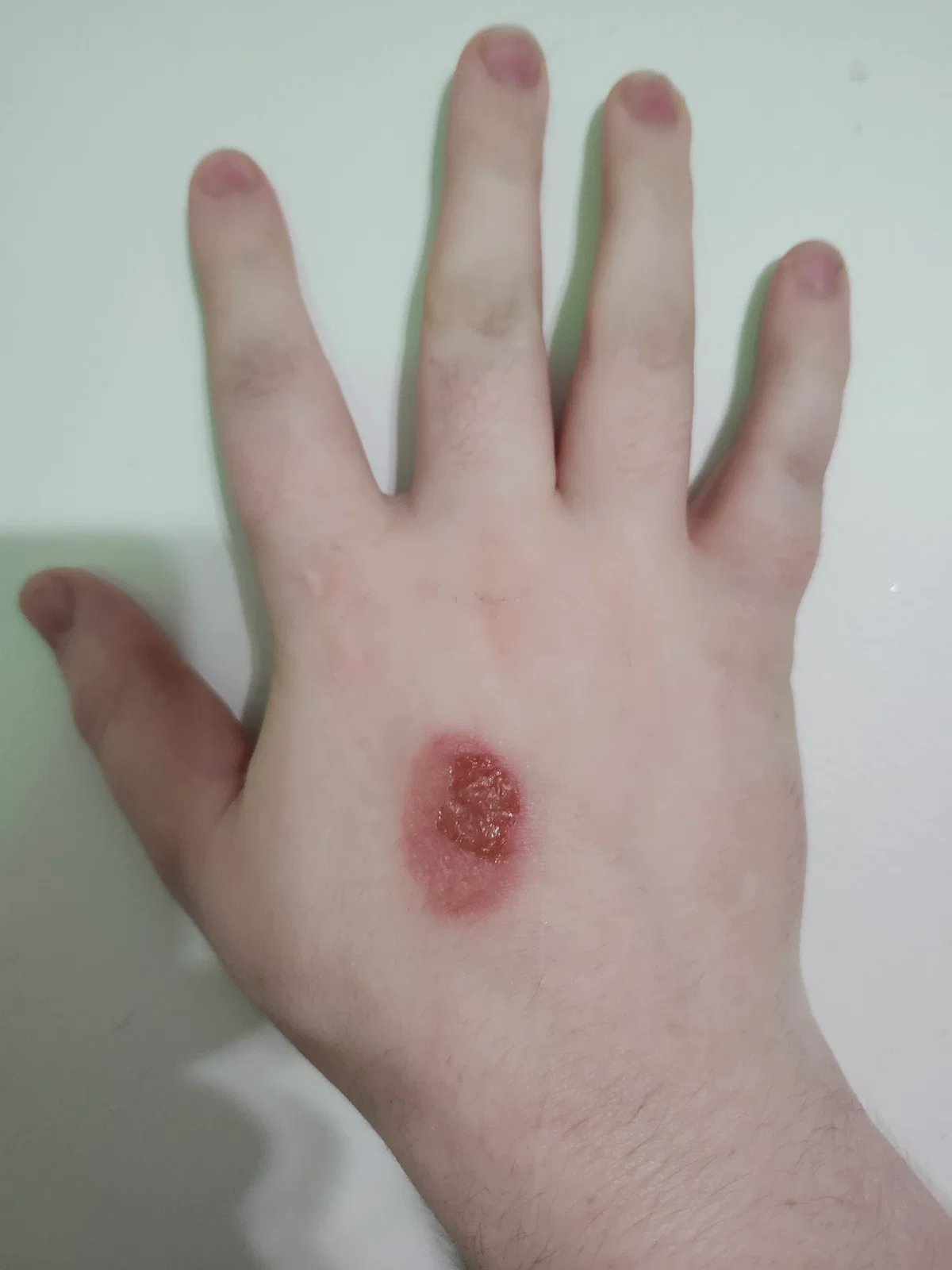 I burnt my hand