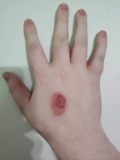 I burnt my hand