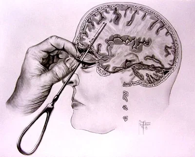 Get Lobotomozied Here // Dr. Hutchins