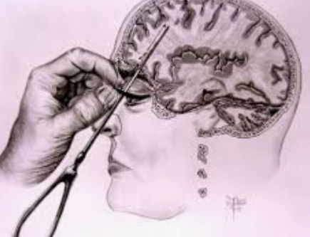 lobotomy simulator